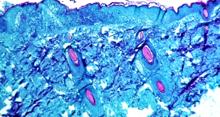 الصحة العالمية: جدري القردة لا يتطلب اجراءات ضخمة كما حدث مع الكورونا
