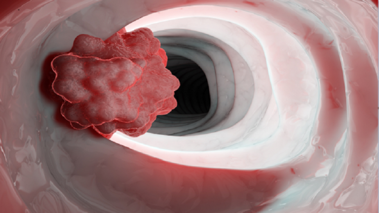خضروات تزيد من خطر الإصابة بسرطان المريء