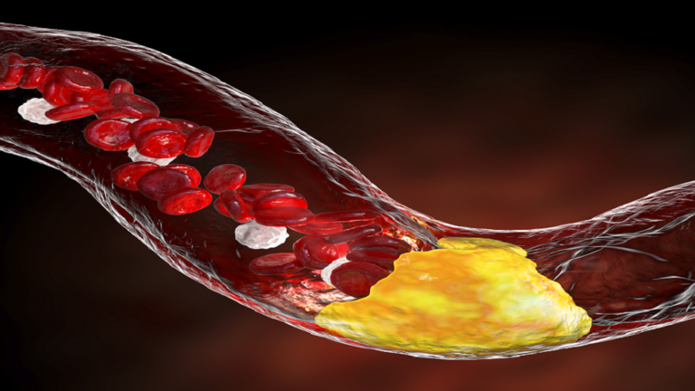 الألم الشديد- قد يكون علامة تحذيرية لارتفاع مستويات الكوليسترول في الدم!