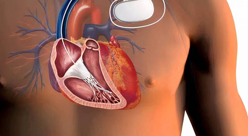 الهواتف الذكية خطر على أجهزة تنظيم ضربات القلب