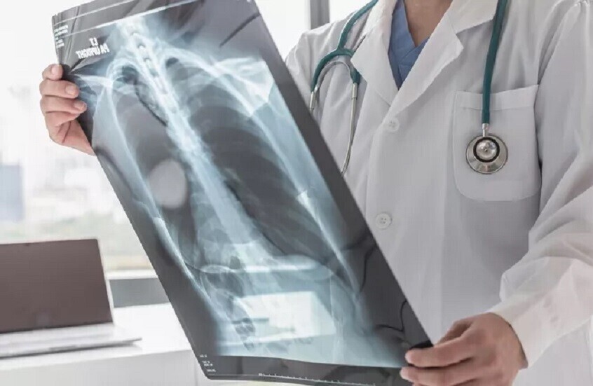 الأعراض الأولى لمرض السل