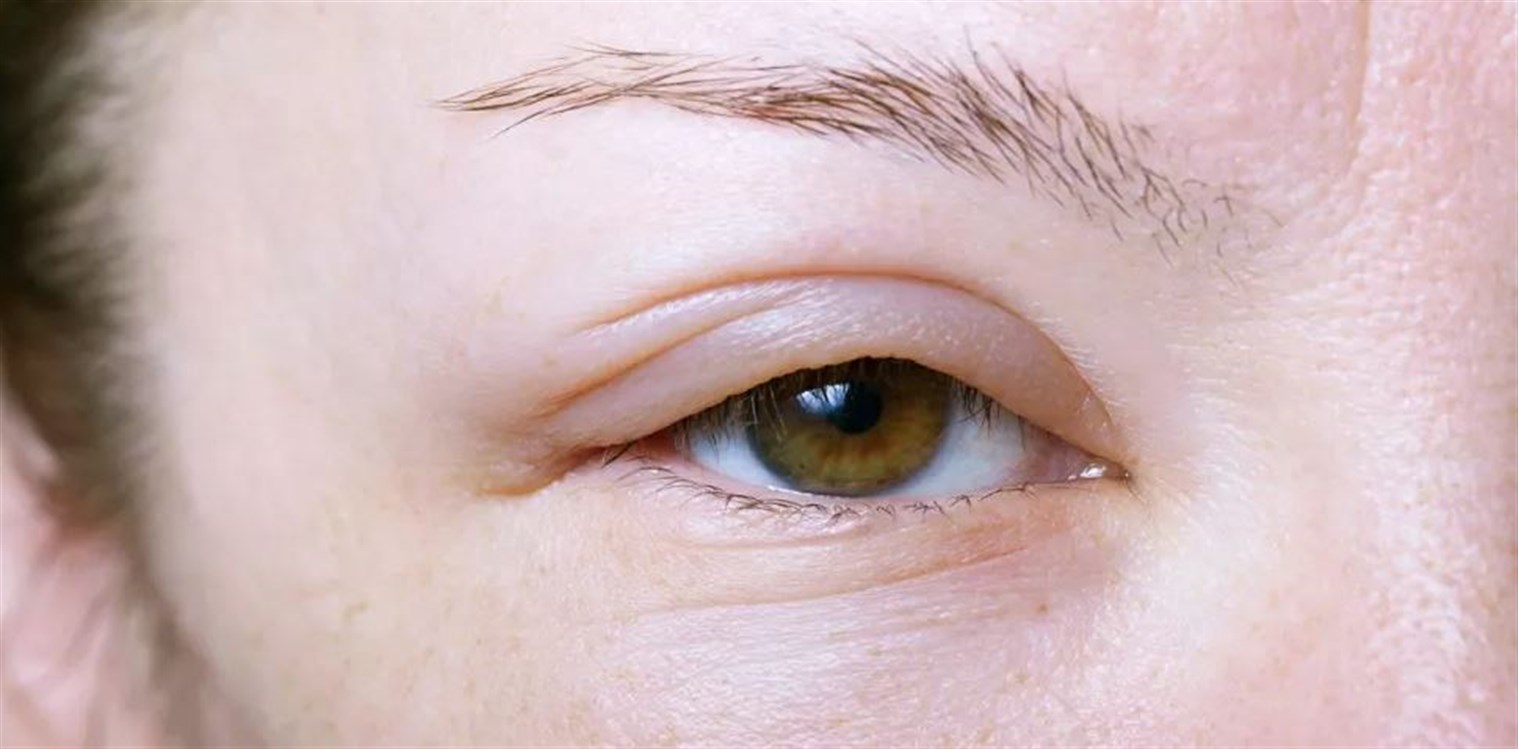 طرق فعالة لمحاربة إنتفاخ العينين في فصل الشتاء