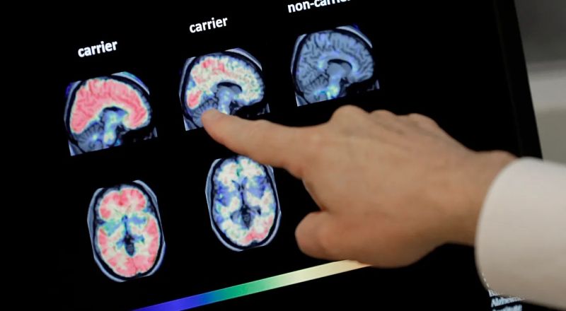 اكتشاف سر العلاقة بين السرطان وانخفاض خطر الخرف